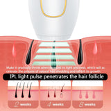 IPL Hair Removal
